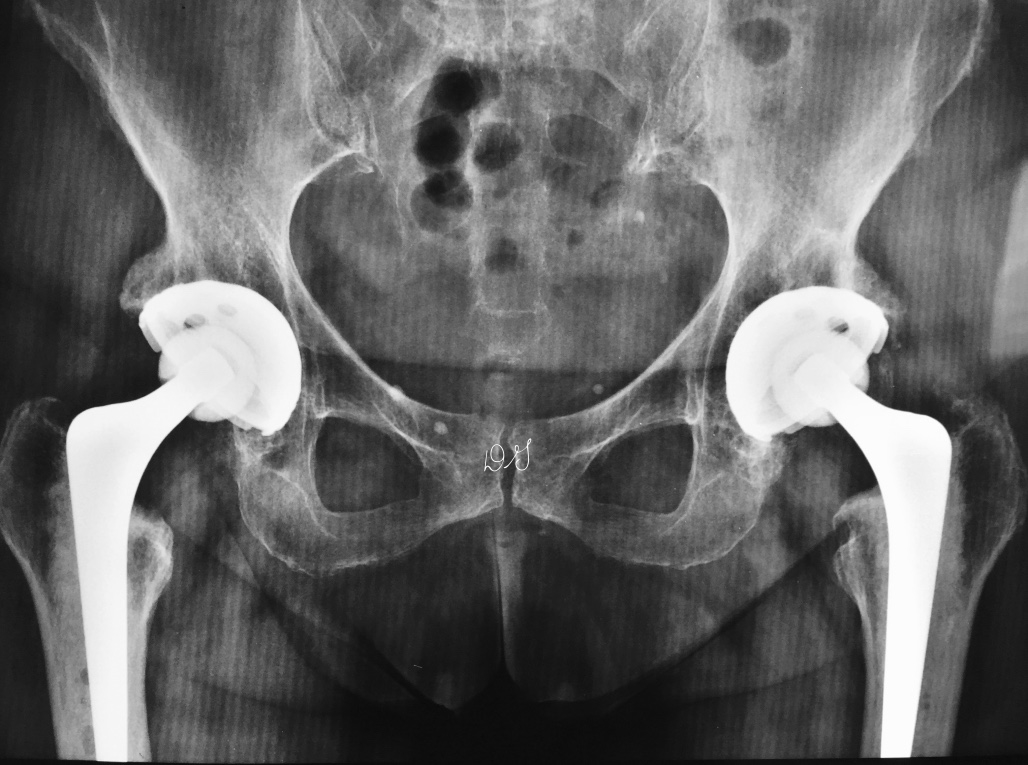 Artroplastia total de Quadril Exeter - Híbrida - Cerâmica - Polietileno high-cross-linked