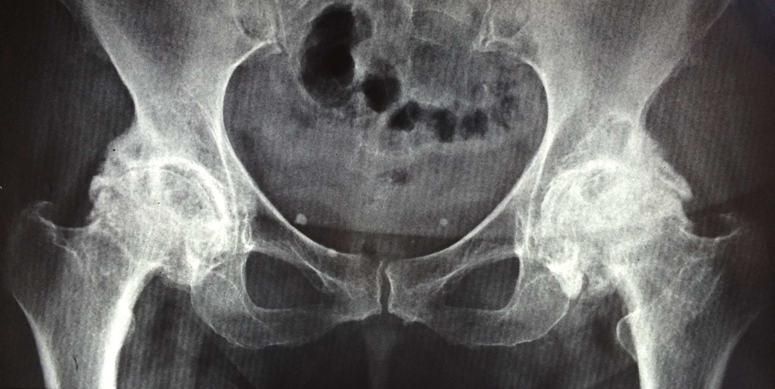 Artrose severa de quadril bilateral