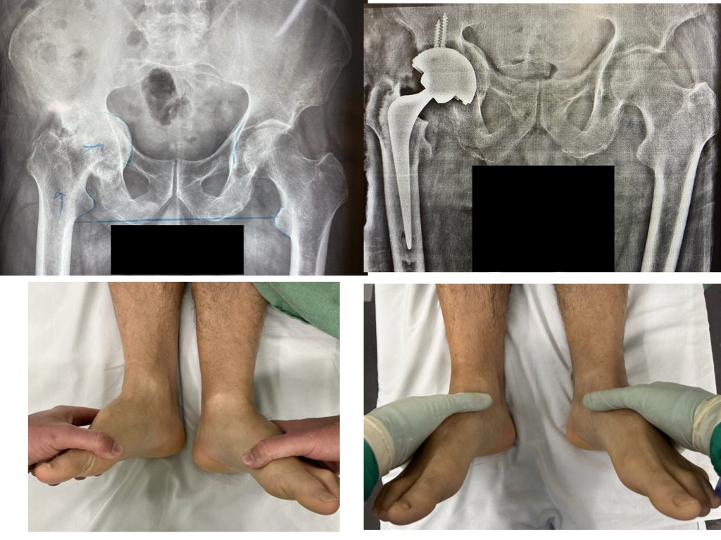 Correção da diferença de comprimento devido à artrose severa do quadril direito com uso de enxerto, parafusos e implante especial no acetábulo.