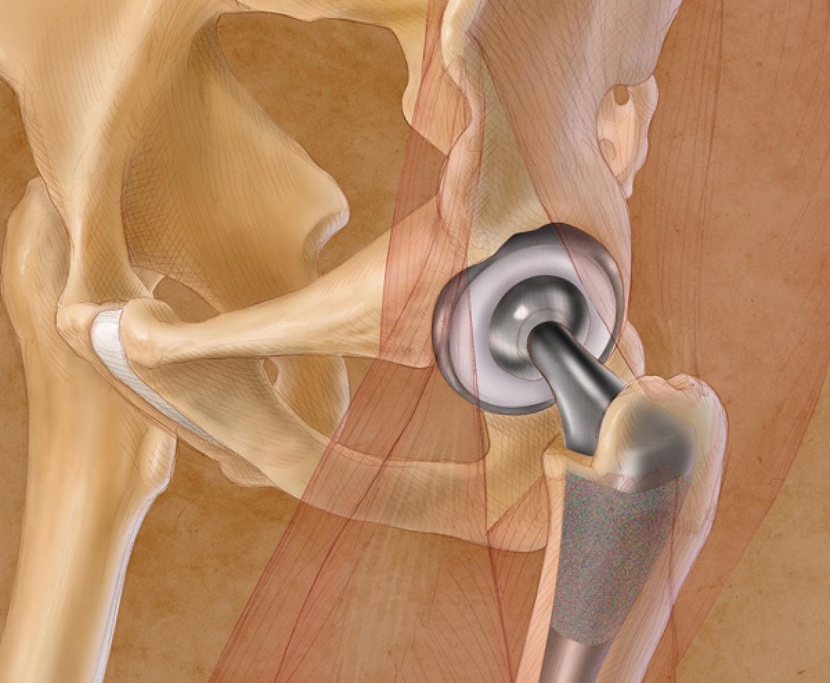 Número de pacientes com Prótese total de Quadril e Joelho devem aumentar