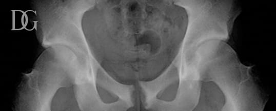 Impacto Femoroacetabular no atleta: padrão de lesões secundárias compensatórias