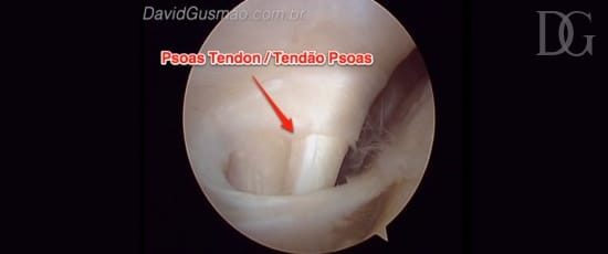 Tendão do músculo Psoas anormalmente intra articular no quadril