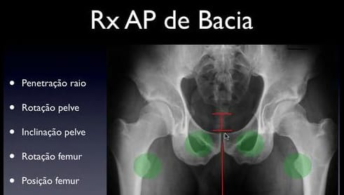 II Jornada de Cirurgia Preservadora do Quadril – Porto Alegre – RS